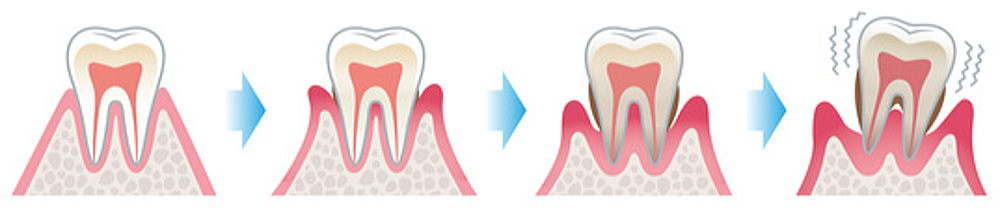 歯周病の進行イメージ