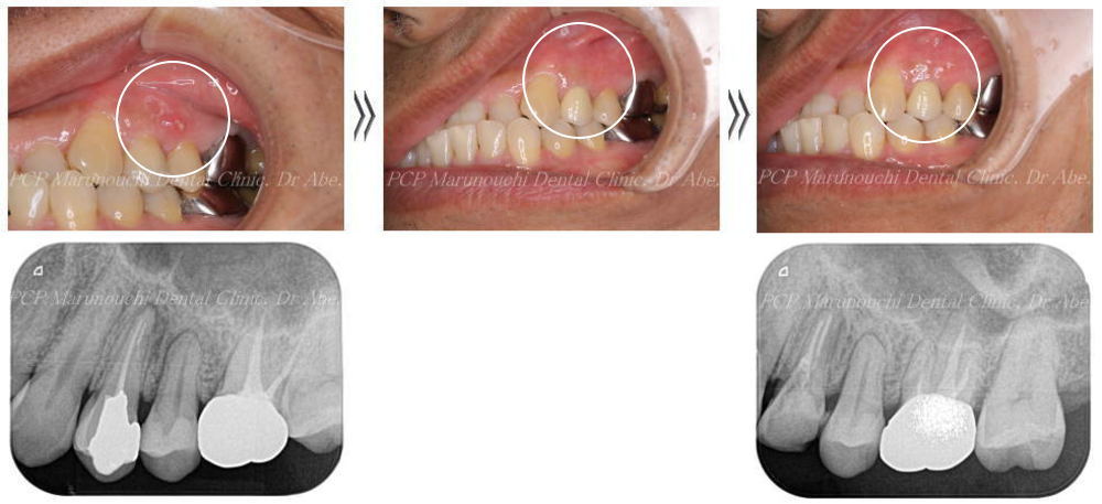 マイクロスコープを使用した精密歯科治療