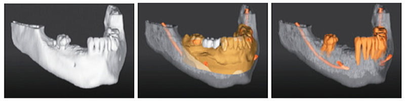 骨形態・・プランニング・及び下歯槽神経